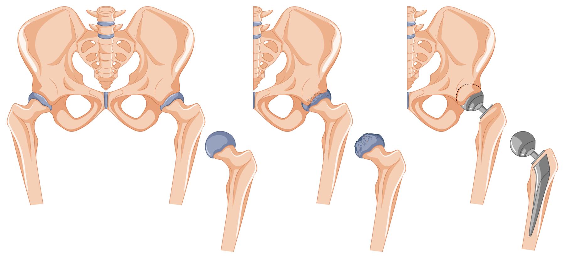 total hip replacement